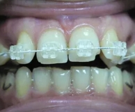 Брекет-системы без удаления зубов